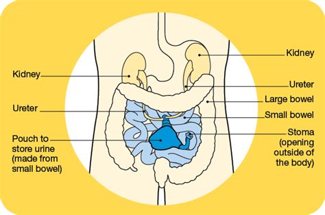 Incontinent Urinary Diversion