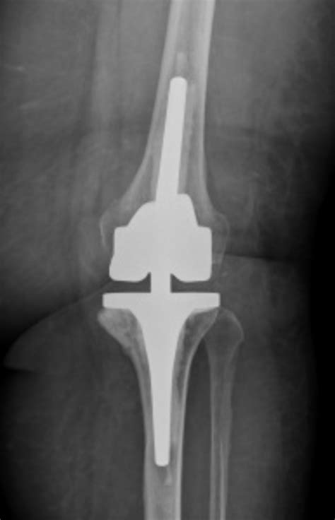 Primäre Knieprothesenimplantation Orthopädie Klinikum Dortmund