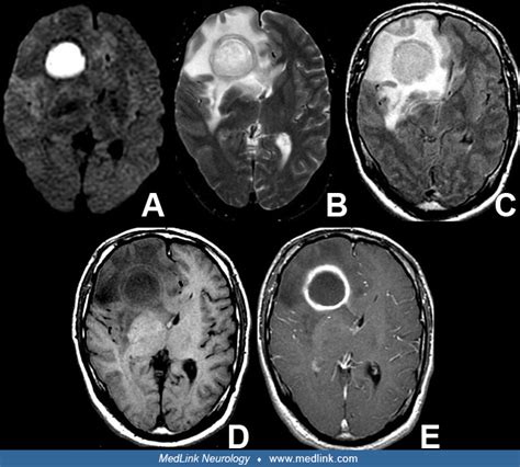 Brain Abscess Medlink Neurology