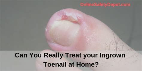 Can You Really Treat Your Ingrown Toenail At Home Industrial And