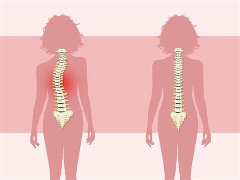 Is Scoliosis More Common In Females Analyzing Gender Differences In