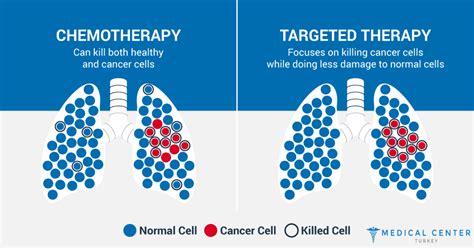 Lung Cancer Treatment in Turkey - Medical Center Turkey