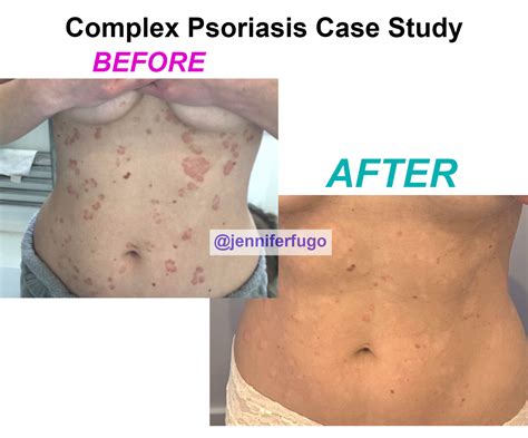 Guttate Scalp Psoriasis Treatment Case Study With Loads Of