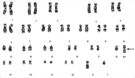 Prenatal Diagnosis And Molecular Cytogenetic Analysis Of A De Novo Isodicentric Chromosome 18