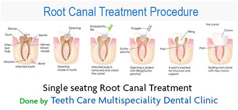 Root Canal Crown Fell Off