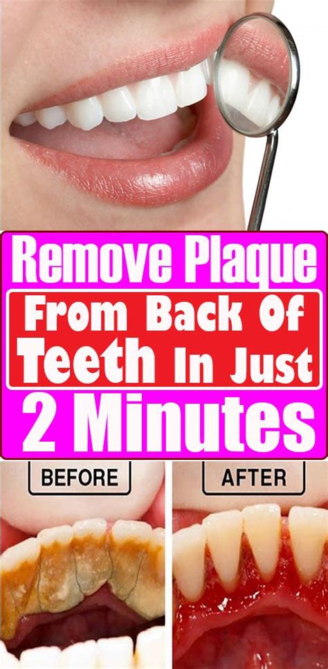 How To Remove Plaque From Teeth Instantly Howotremvo