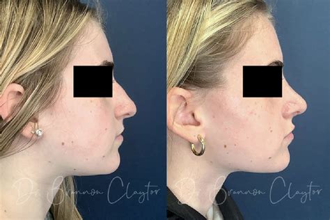 Rhinoplasty Recovery Everything You Can Expect Claytor Noone