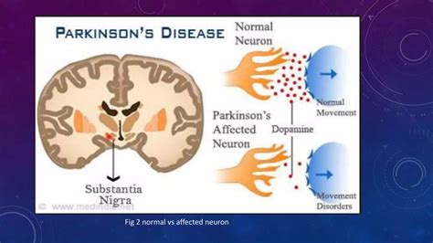 Detection Of Parkinsons Disease Using Python Pptx