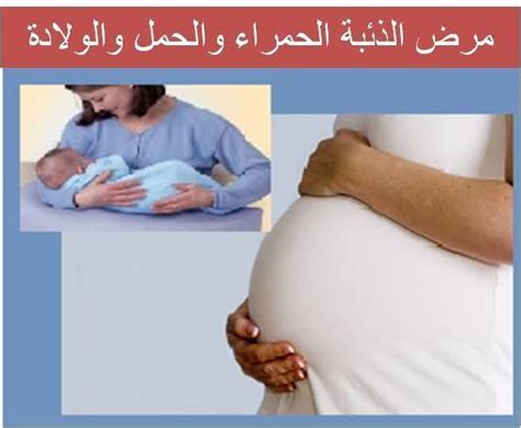 الذئبة الحمراء وتأثيرها على الحمل والرضاعة مقالة عربية