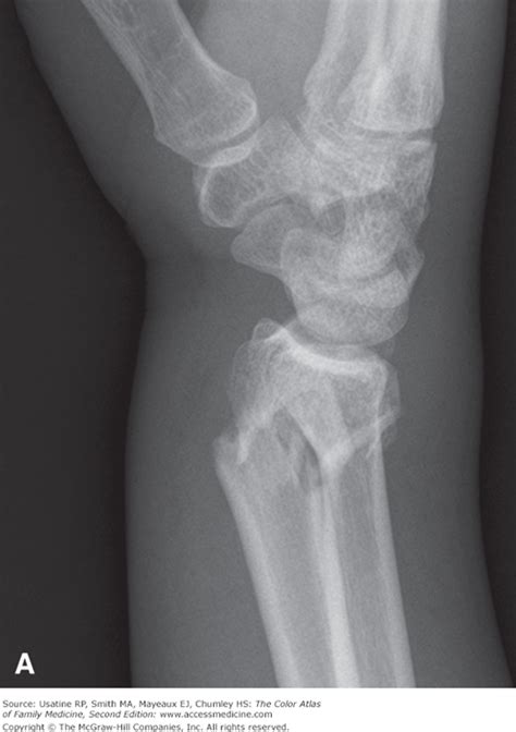 Distal Radius Fracture | Basicmedical Key