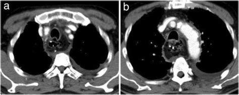 Chest Contrast Computed Tomography Findings Contrast Enhancement Was