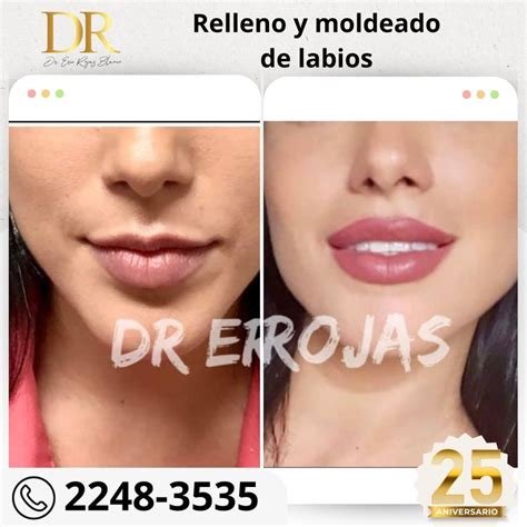 Relleno y moldeado de labios en promoción Dr Eric Rojas