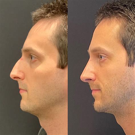 Rhinoplasty Austin Tx Dr Weinfeld