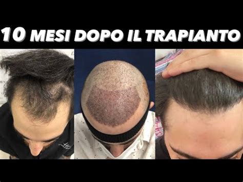 Il Trapianto Di Capelli Di Un Mio Iscritto In Turchia Youtube