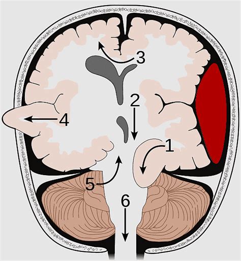 Cerebellar Tentorium Brain Herniation Cerebral Edema Uncus Falx