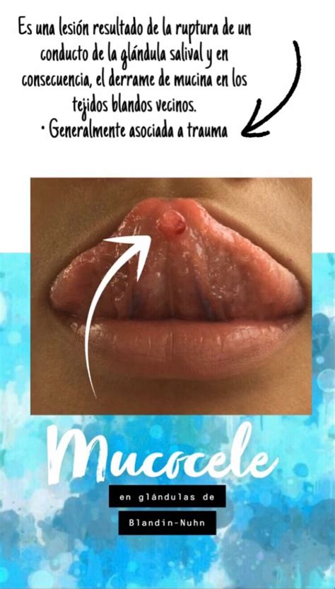 Mucocele