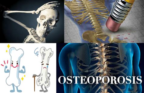 Prevenir La Osteoporosis En 3 Pasos ~ Natwiki