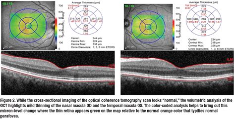 Signature OCT Findings As A Diagnostic Tool