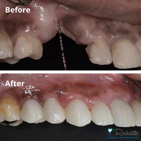 Dental Bone Grafting Ottawa Rockcliffe Dental And Denture Centre