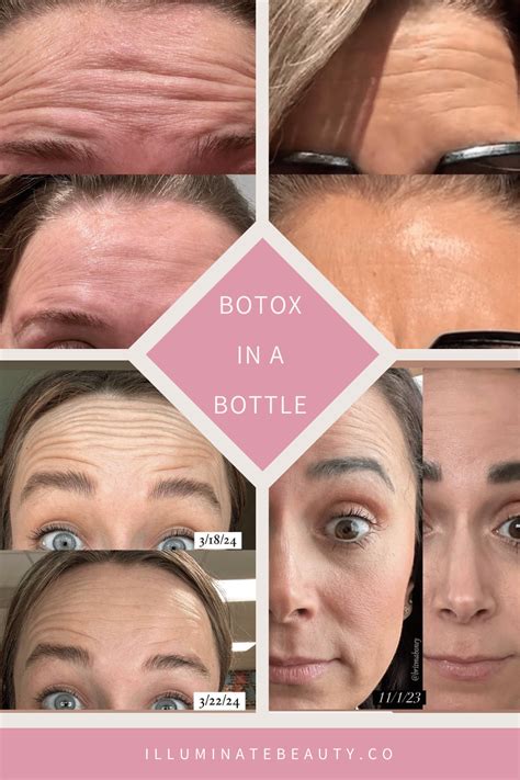 Botox Alternatives Youthful Skin Without Botox Illuminate Beauty