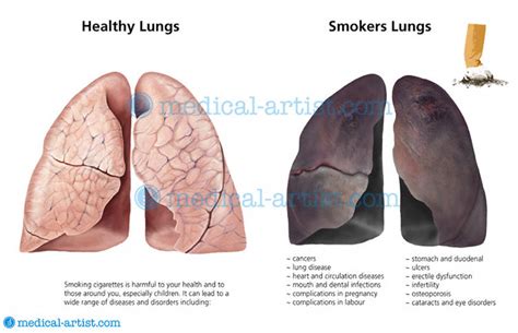 Medical Conditions: Medical Conditions Of The Lungs