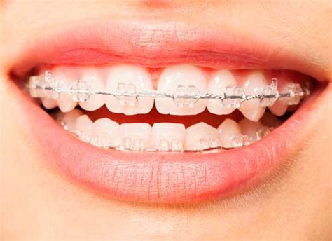 Invisalign Bogot Alineadores Clear Aligner Ortodoncia Sin Brackets