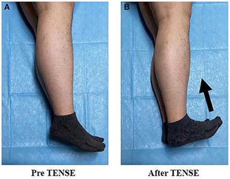 Frontiers Calf Muscle Pump Tensing As A Novel Maneuver To Improve The