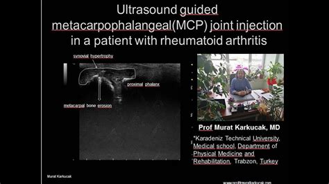 Ultrasound Guided Metacarpophalangeal Mcp Joint Injection In A Patient With Rheumatoid