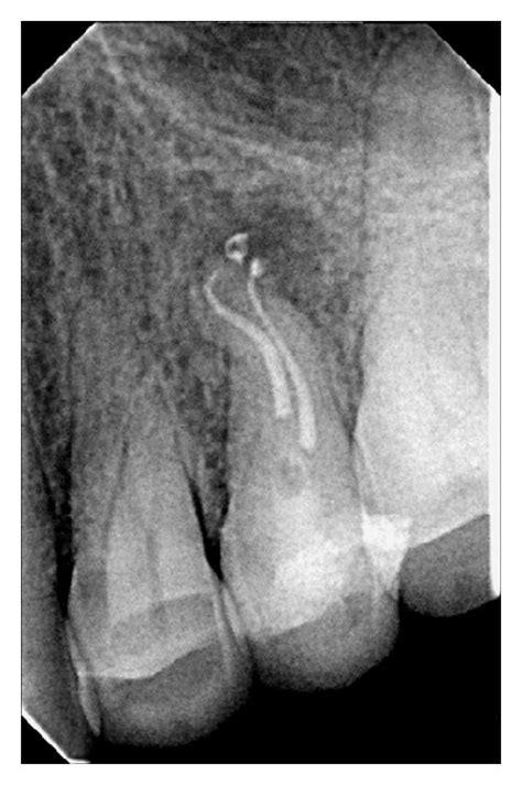 A Initial Radiograph Showing Periapical Radiolucency B