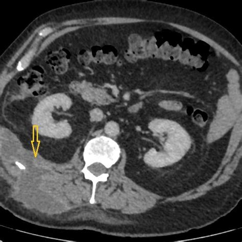 Laparoscopic View Showing The Right Paracolic Gutter After Carefully