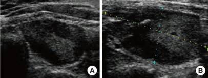 Ultrasonographic Findings Of A Parathyroid Adenoma At A Local Hospital