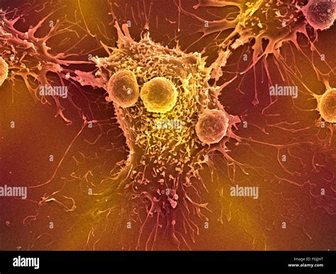 T Lymphocytes And Cancer Cell Coloured Scanning Electron Micrograph