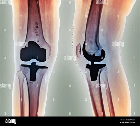 Total Knee Replacement High Resolution Stock Photography And Images Alamy