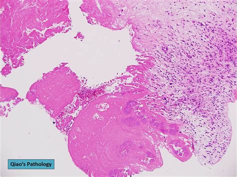 Qiao S Pathology Aortic Valve Vegetation And Bacterial Endocarditis