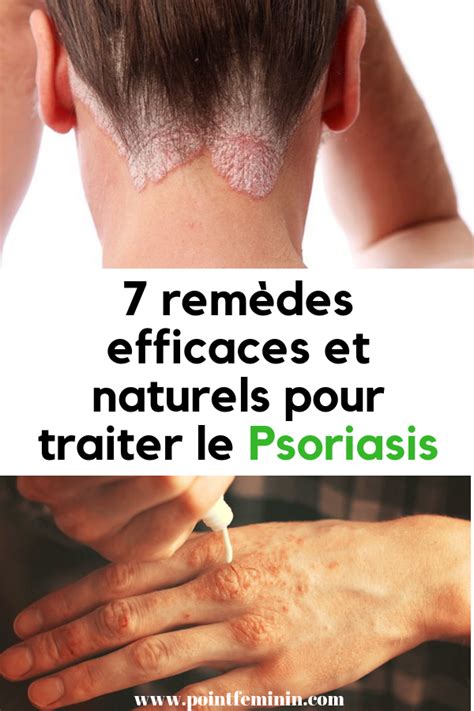 Rem Des Efficaces Et Naturels Pour Traiter Le Psoriasis Avec Images