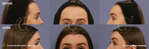 Forehead Reduction Dr Cengizhan Ekizceli