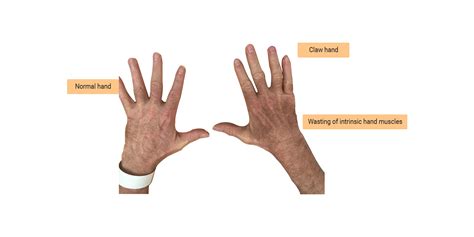 Cubital Tunnel Syndrome Claw Hand