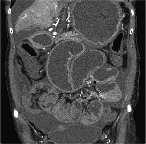 Autoimmune Gastrointestinal Dysmotility In A Patient With Hi Acg