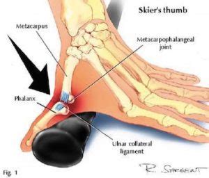 Skier's Thumb - Ryde Natural Health Clinic