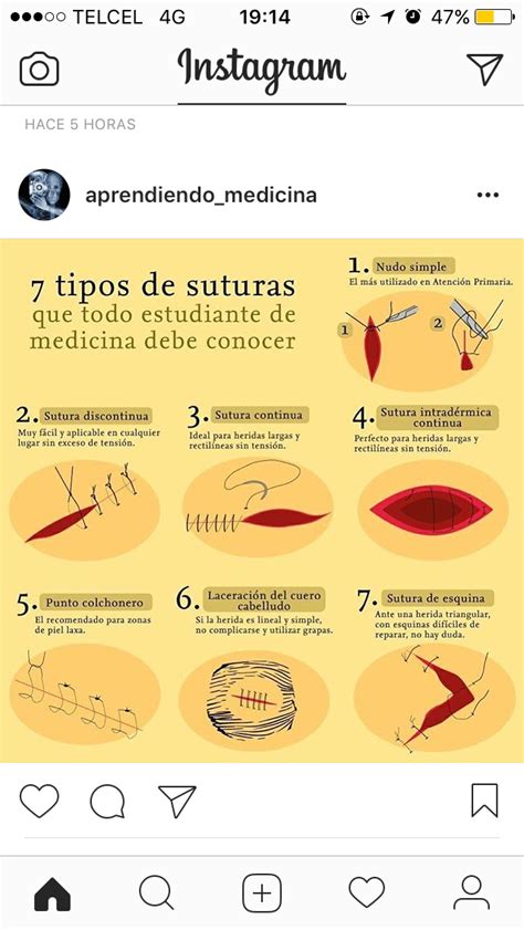 Tipos de sutura Tipos de suturas Cuidados de enfermería Fundamentos