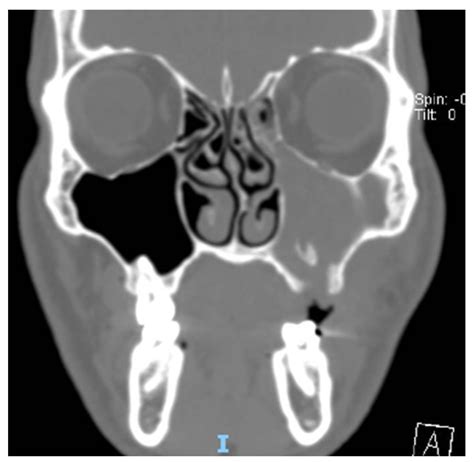 Antibiotics Free Full Text Odontogenic Sinusitis From Classical