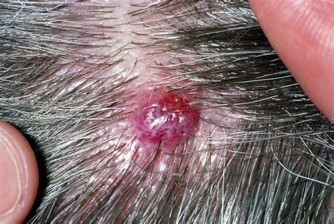 Cherry Hemangioma Scalp