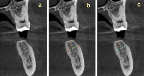 Measurements Evaluated On Cbct Images A Crestal Soft Tissue Thickness