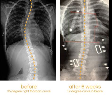 Non Surgical Treatment For Scoliosis