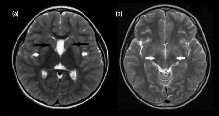 Pediatric MRI Brain: Normal or abnormal, that is the question.