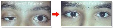 Drooping Eyelids Ptosis Surgery In Thane Id