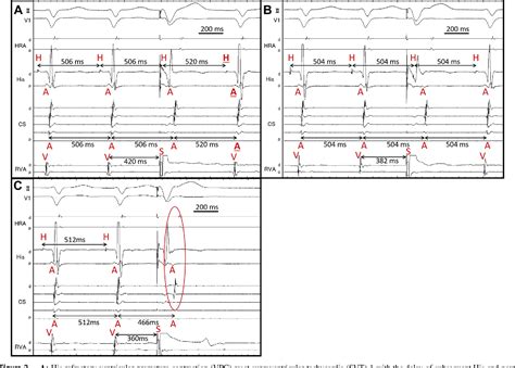 Figure From A Case Of Typical And Atypical Atrioventricular Nodal