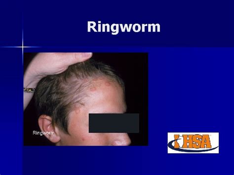 Common skin conditions in wrestling Ringworm Impetigo Mulluscum