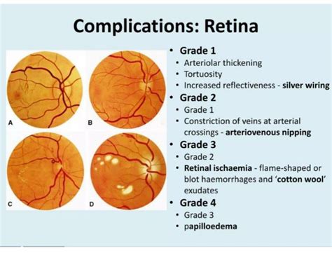 Hypertension Retinopathy Ii Medizzy