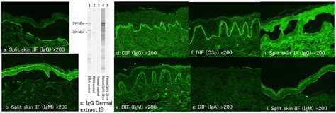 Frontiers Case Report A Case Of Epidermolysis Bullosa Acquisita With Igg And Igm Anti